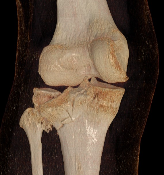 Posterolateral Tibial Plateau